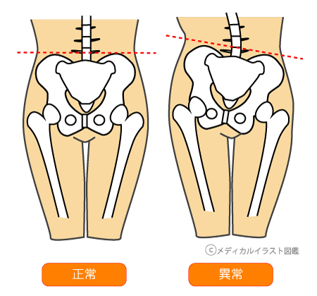 骨盤のゆがみ